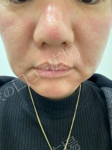 治療直後の症例写真