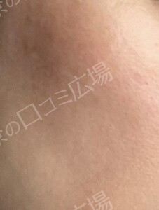 治療直後の症例写真