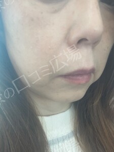 治療直後の症例写真