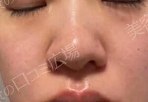 治療直後の症例写真
