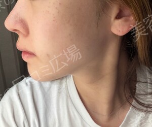 治療直後の症例写真