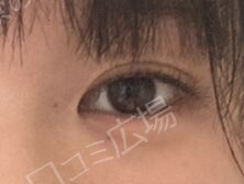 治療直後の症例写真
