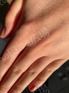 治療直後の症例写真