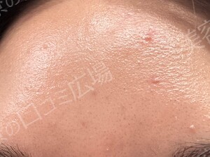 治療直後の症例写真