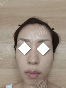 治療直後の症例写真