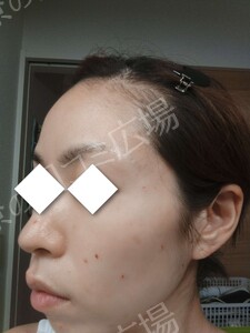 治療直後の症例写真