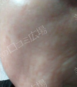 治療直後の症例写真