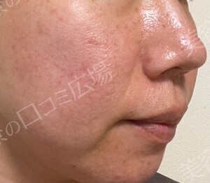 治療直後の症例写真