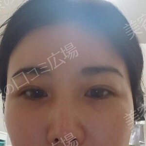 【おすすめ！】　涙袋ヒアルロン酸（0.1㏄）の治療前の症例写真