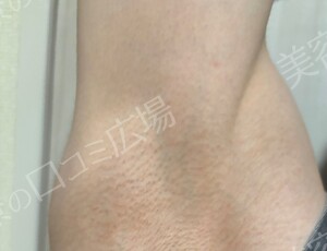治療直後の症例写真