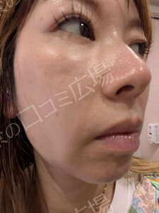 治療直後の症例写真