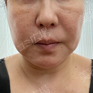 治療直後の症例写真