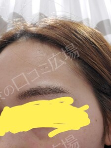 治療直後の症例写真