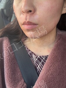 治療直後の症例写真