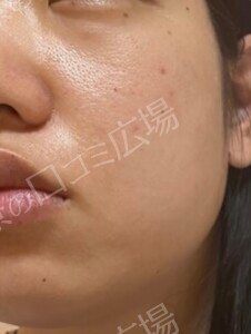 治療直後の症例写真