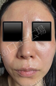 治療直後の症例写真