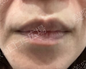 筋肉・美容クリニックのアートメイクの症例写真[ビフォー]