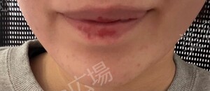 ピコレーザーピコレーザートーニングの治療直後の症例写真
