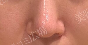 ハイドラジェントル｜毛穴の黒ずみを集中的に除去の治療結果の症例写真