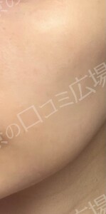 フォトフェイシャルStellar M22の治療結果の症例写真