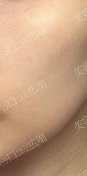新宿ラクル美容外科クリニックの症例写真[アフター]