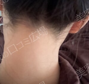 治療直後の症例写真