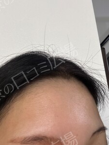 治療直後の症例写真
