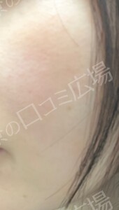 治療直後の症例写真