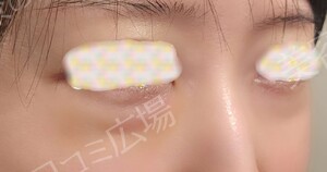 治療直後の症例写真