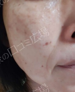 治療前の症例写真