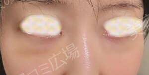 治療直後の症例写真