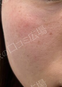 治療直後の症例写真