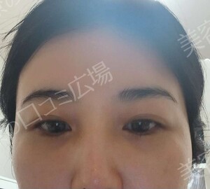 【おすすめ！】　涙袋ヒアルロン酸（0.1㏄）の治療前の症例写真