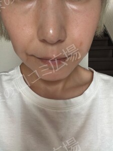 治療直後の症例写真