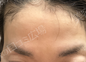 治療直後の症例写真