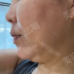 治療直後の症例写真