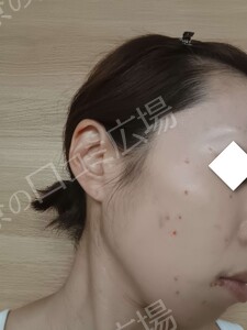 治療直後の症例写真
