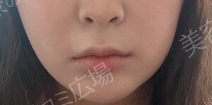 治療直後の症例写真
