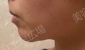 治療直後の症例写真