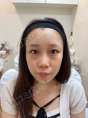 Theoryクリニック （セオリークリニック）の目元の症例写真[ビフォー]