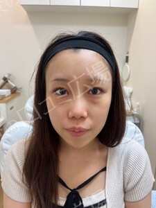 【筒井院長】脱脂術＋ピュアグラフティング　リポキューブの治療前の症例写真
