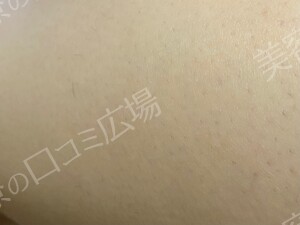 口コミ広場会員様限定！全身脱毛5回コース 146,300円の治療結果の症例写真