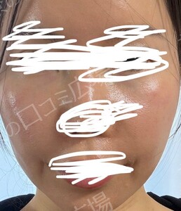 治療直後の症例写真