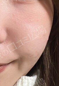 治療直後の症例写真