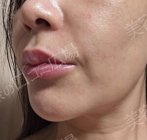 治療直後の症例写真