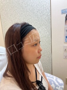 【筒井院長】脱脂術＋ピュアグラフティング　リポキューブの治療前の症例写真