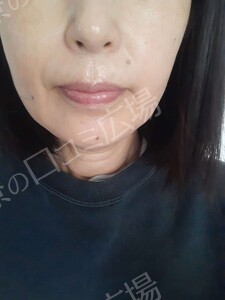 治療直後の症例写真