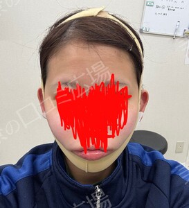 治療直後の症例写真