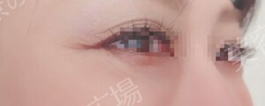治療直後の症例写真