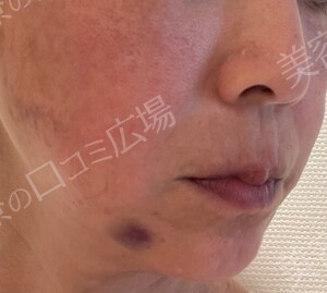 治療直後の症例写真